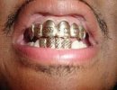bling_teeth_32.jpg