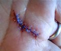stitches.jpg