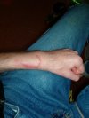 wound_04_resize.jpg