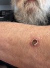 Arm scab.jpg