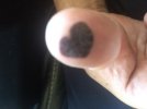 Heart blister.jpg