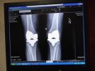 Knees X-ray.jpg