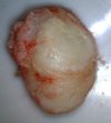 cyst (2).jpg