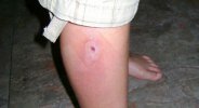 TannerBite (3).jpg