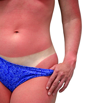 Sunburn.jpg
