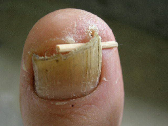 Ingrown_toenail_toothpick.jpg