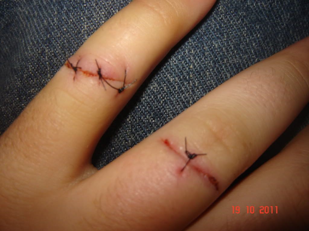 Stitches.jpg