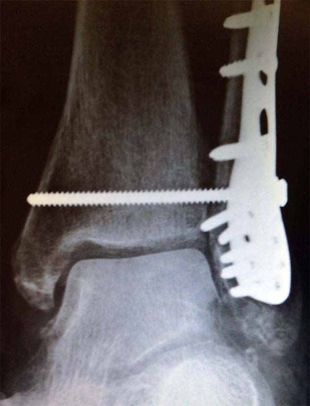 Plates_screws_pin.jpg