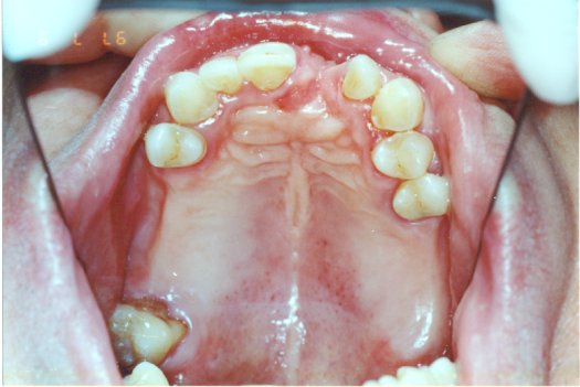 removable_partial_dentures_03.jpg